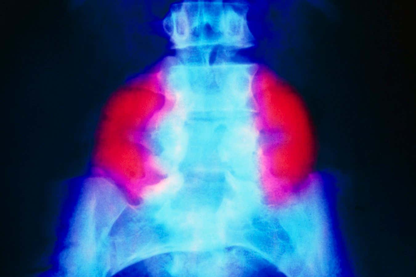 Stem cell patch reverses brain damage in fetuses with spina bifida